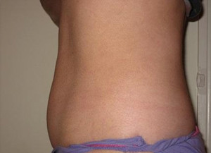 Trusculpt Before and After | Little Lipo