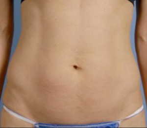 Trusculpt Before and After | Little Lipo