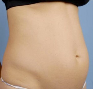 Trusculpt Before and After | Little Lipo