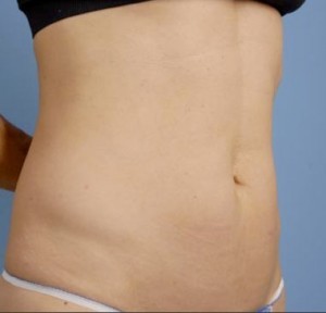 Trusculpt Before and After | Little Lipo