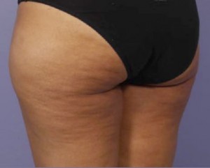 Trusculpt Before and After | Little Lipo