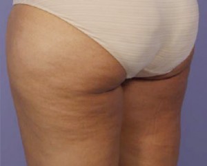 Trusculpt Before and After | Little Lipo