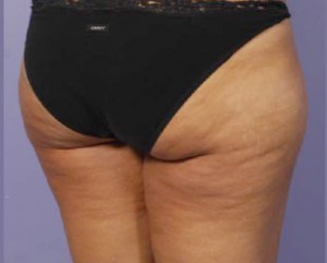 Trusculpt Before and After | Little Lipo