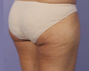 Trusculpt Before and After | Little Lipo