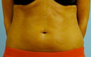 Trusculpt Before and After | Little Lipo