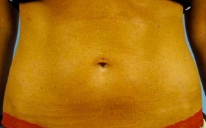 Trusculpt Before and After | Little Lipo