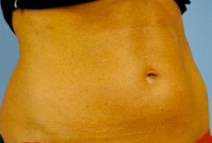 Trusculpt Before and After | Little Lipo