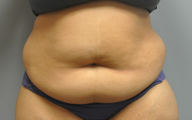 Tummy Tuck Before and After | Little Lipo