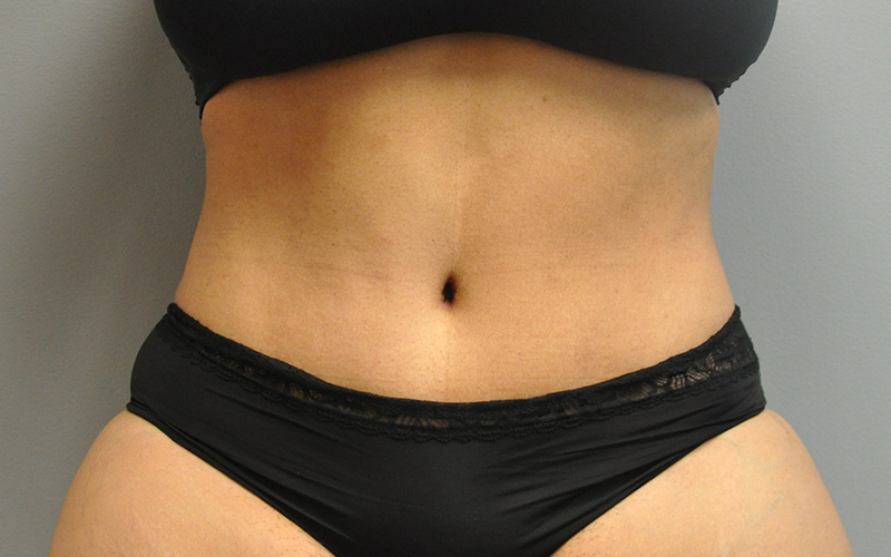 Tummy Tuck Before and After | Little Lipo