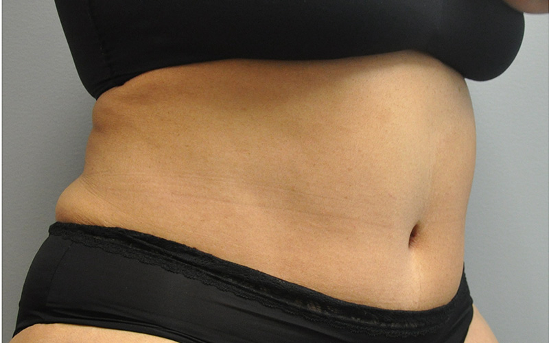 Tummy Tuck Before and After | Little Lipo