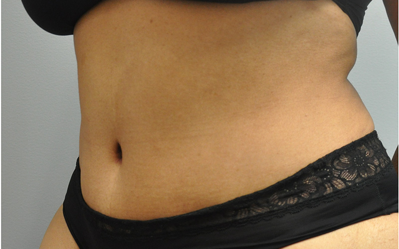 Tummy Tuck Before and After | Little Lipo