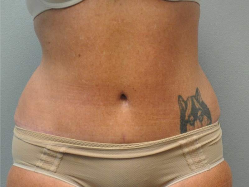 Tummy Tuck Before and After | Little Lipo