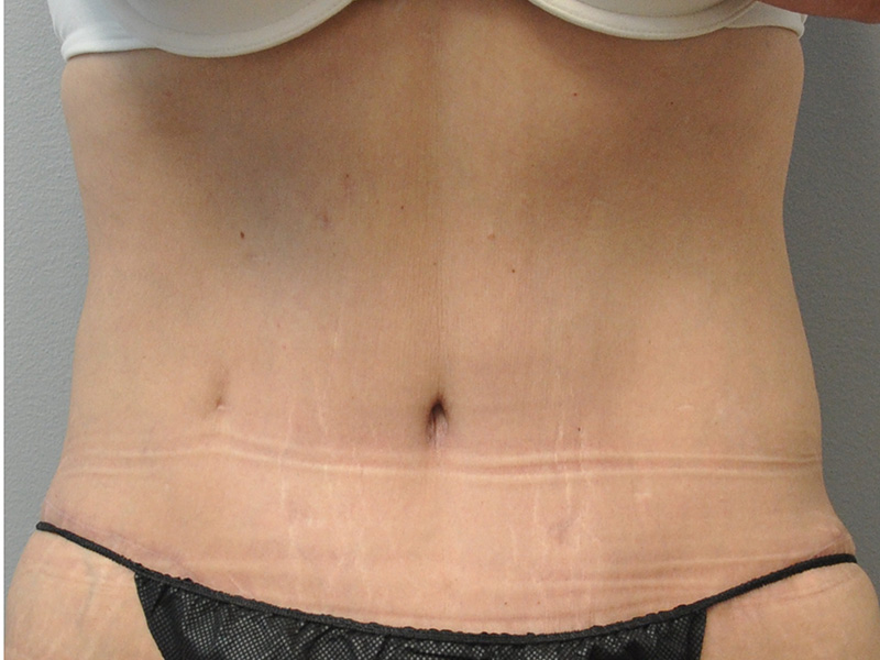 Tummy Tuck Before and After | Little Lipo