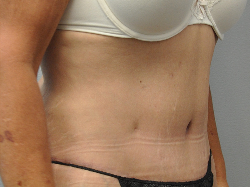 Tummy Tuck Before and After | Little Lipo