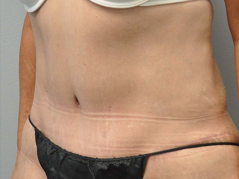 Tummy Tuck Before and After | Little Lipo