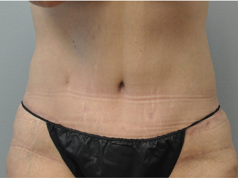 Tummy Tuck Before and After | Little Lipo