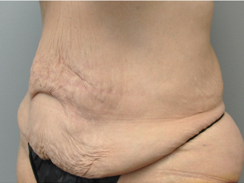 Tummy Tuck Before and After | Little Lipo