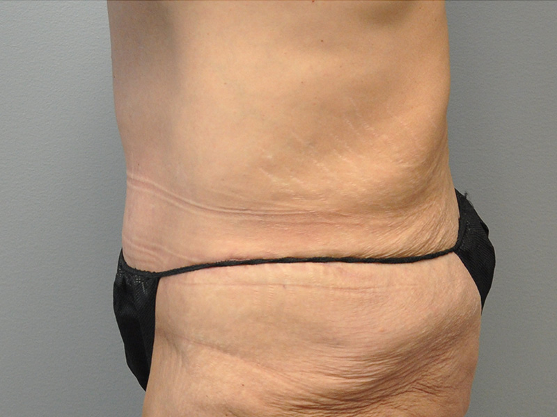 Tummy Tuck Before and After | Little Lipo