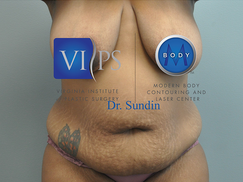 Tummy Tuck Before and After | Little Lipo