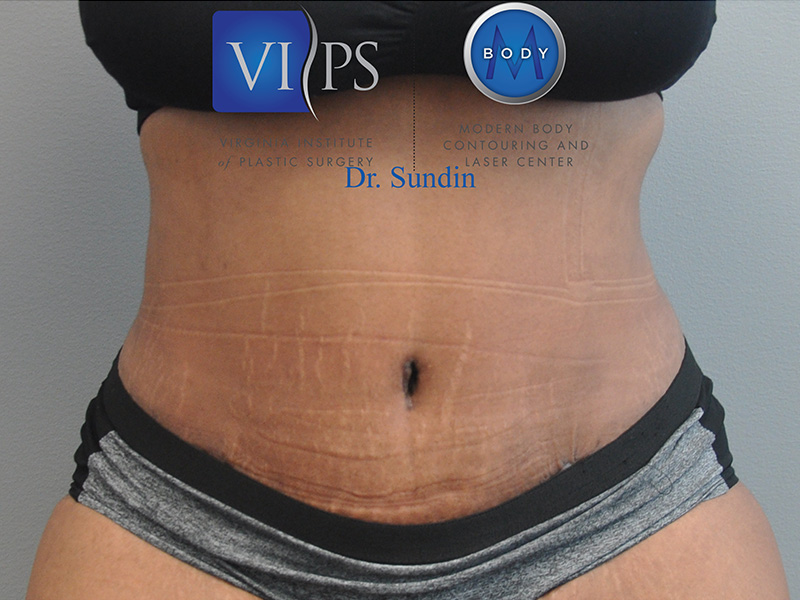 Tummy Tuck Before and After | Little Lipo