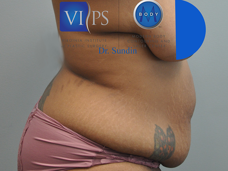 Tummy Tuck Before and After | Little Lipo