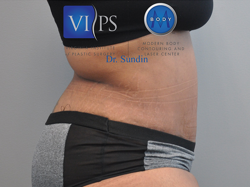 Tummy Tuck Before and After | Little Lipo