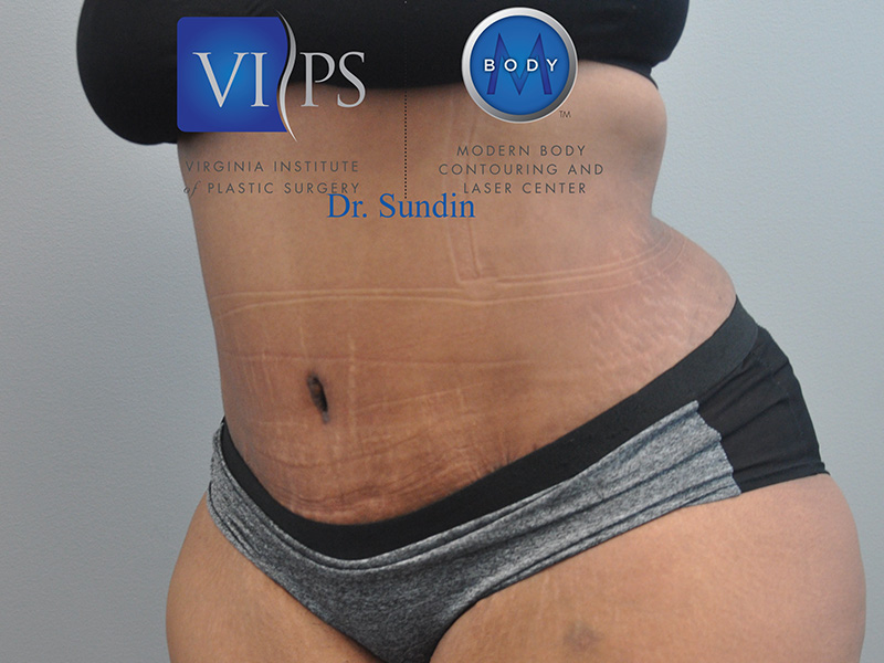 Tummy Tuck Before and After | Little Lipo