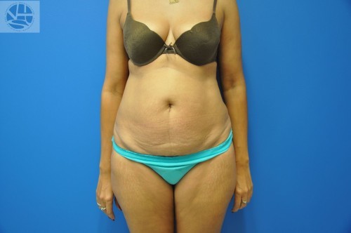 Tummy Tuck Before and After | Little Lipo