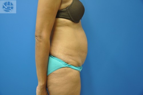 Tummy Tuck Before and After | Little Lipo