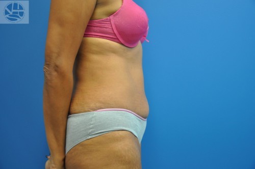 Tummy Tuck Before and After | Little Lipo