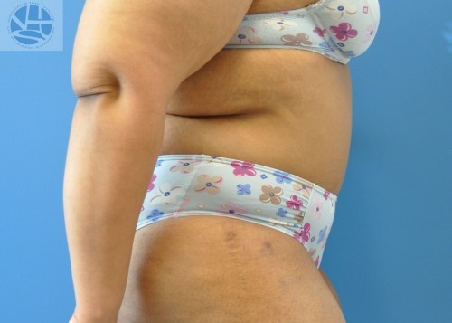 Tummy Tuck Before and After | Little Lipo