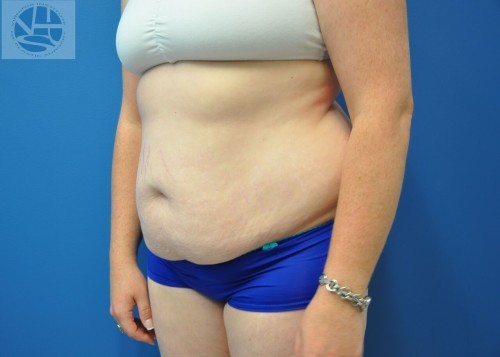 Tummy Tuck Before and After | Little Lipo