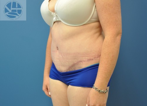 Tummy Tuck Before and After | Little Lipo