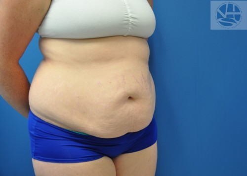Tummy Tuck Before and After | Little Lipo