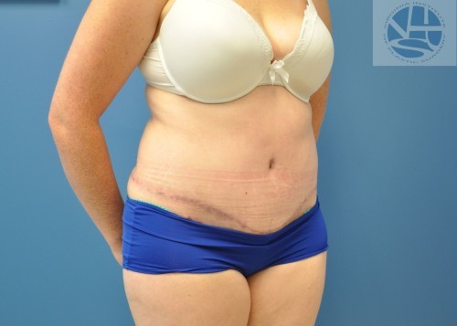 Tummy Tuck Before and After | Little Lipo