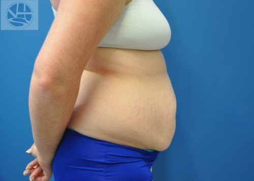 Tummy Tuck Before and After | Little Lipo