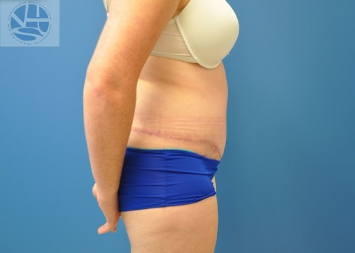 Tummy Tuck Before and After | Little Lipo