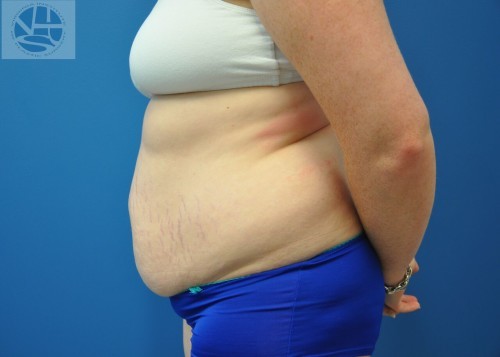 Tummy Tuck Before and After | Little Lipo