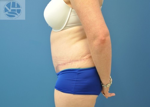 Tummy Tuck Before and After | Little Lipo
