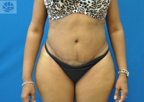 Tummy Tuck Before and After | Little Lipo