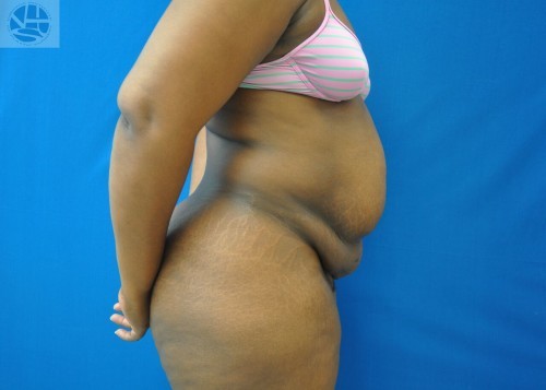 Tummy Tuck Before and After | Little Lipo