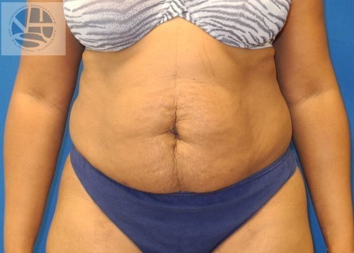 Tummy Tuck Before and After | Little Lipo