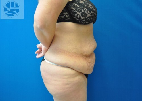 Tummy Tuck Before and After | Little Lipo