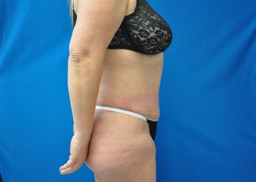 Tummy Tuck Before and After | Little Lipo