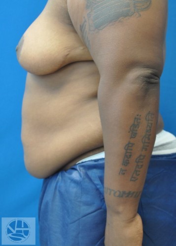 Tummy Tuck Before and After | Little Lipo