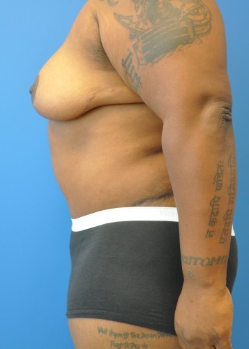 Tummy Tuck Before and After | Little Lipo