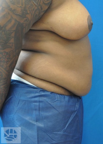 Tummy Tuck Before and After | Little Lipo