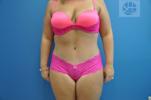 Tummy Tuck Before and After | Little Lipo