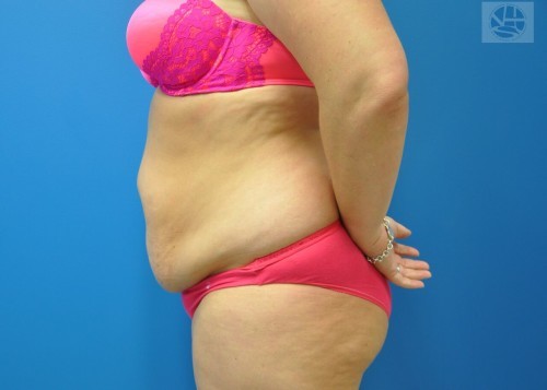 Tummy Tuck Before and After | Little Lipo