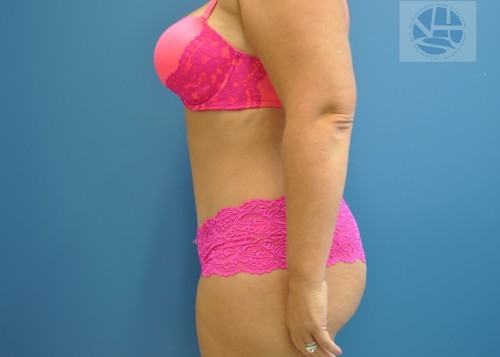 Tummy Tuck Before and After | Little Lipo
